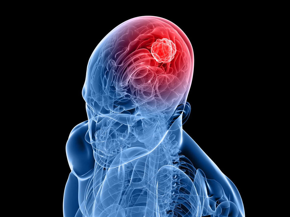 travel insurance benign brain tumour