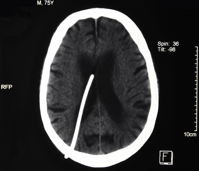Brain CT scan with ventricular catheter
