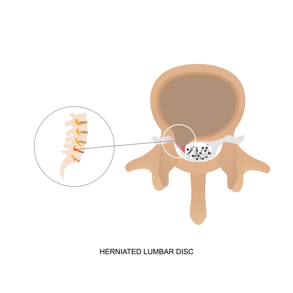 Illustration demonstration of human herniated lumbar disc.