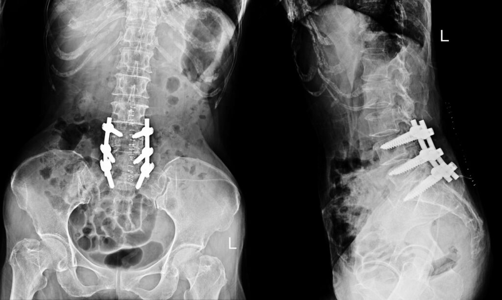 Lower Lumbar Fusion