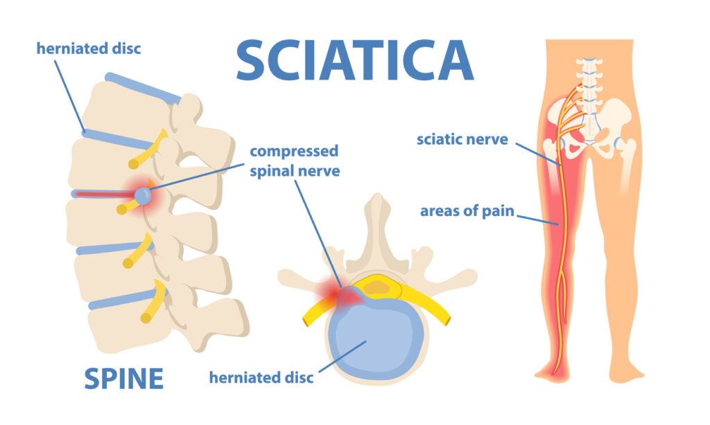 Sciatica Part 1: Symptoms, Causes, Diagnosis, Prevention, Management &  Treatment: Pain Care, LLC: Interventional Spine & Pain Management