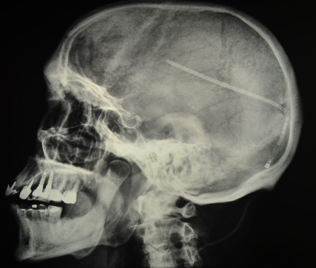 Skull radiography