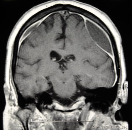 Brain CT scan with subdural hematoma