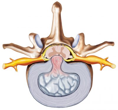 cervical-stenosis-doctor-st-louis