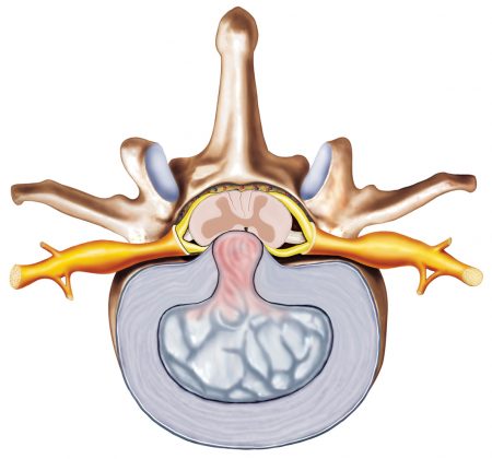 cervical-stenosis-doctor-st-louis