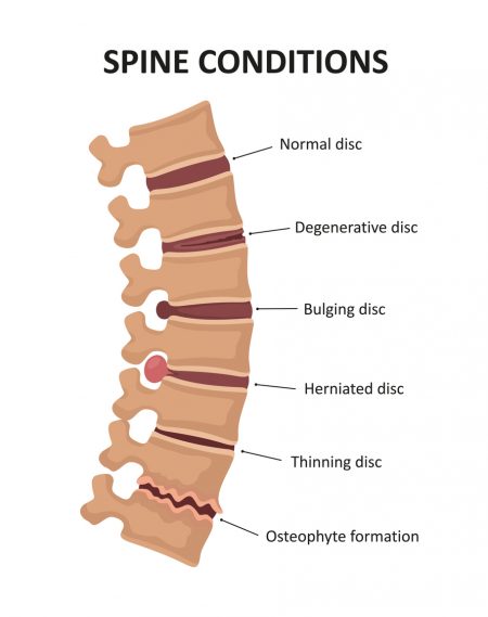 Degenerative Spine Disease Neurosurgery Of St Louis STL Brain 