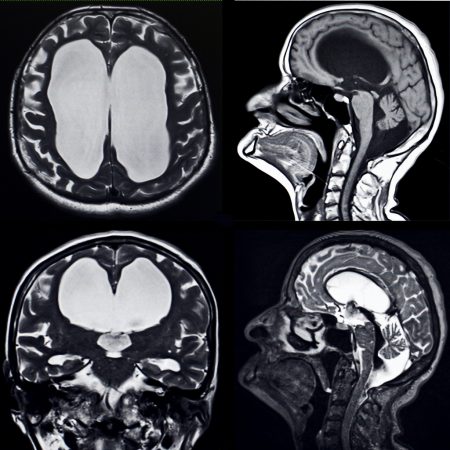 normal pressure hydrocephalus