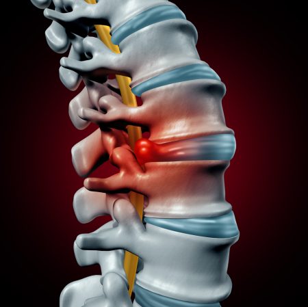 lumbar-microdiscectomy-surgery-st-louis