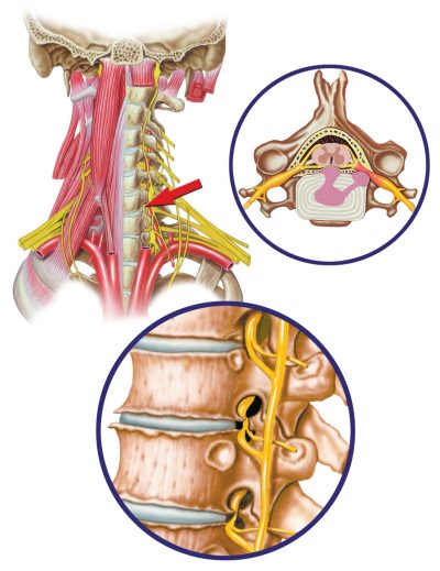 cervicobracalgia