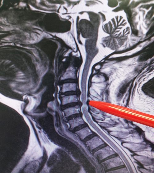 Posterior Cervical Laminectomy and Fusion