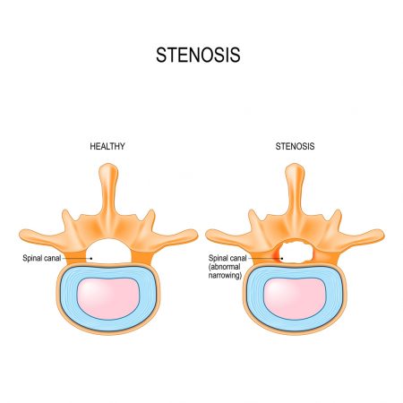 Lumbar Spinal Stenosis is an abnormal narrowing in spinal canal.