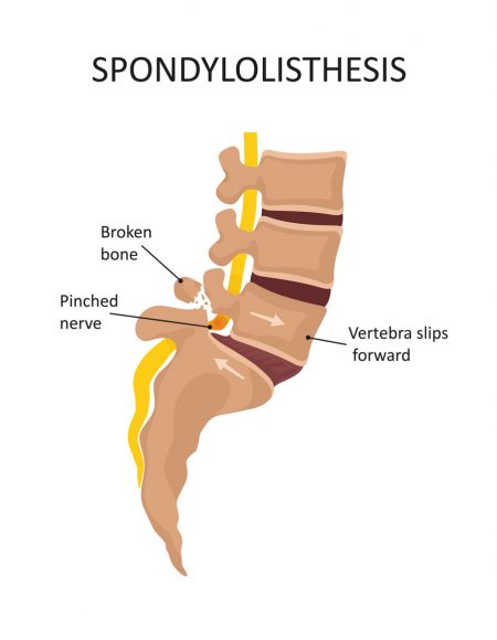 Spondylolisthesis. Pinched nerve