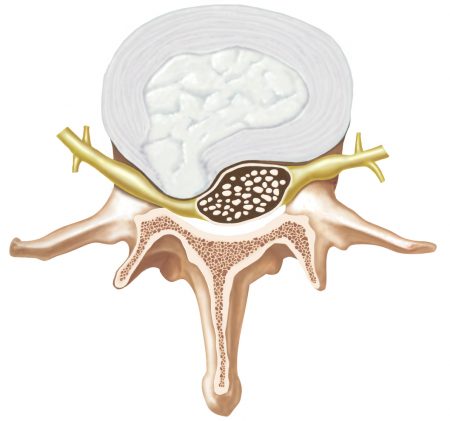 st louis herniated disc doctor