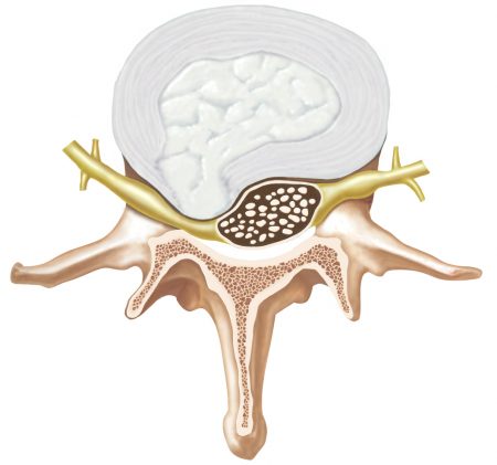 st louis herniated disc doctor