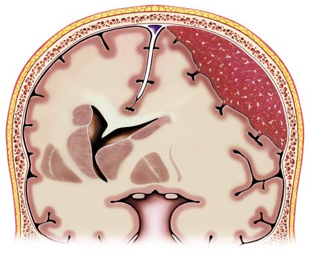 subdural-hamatoma-st-louis-doctor